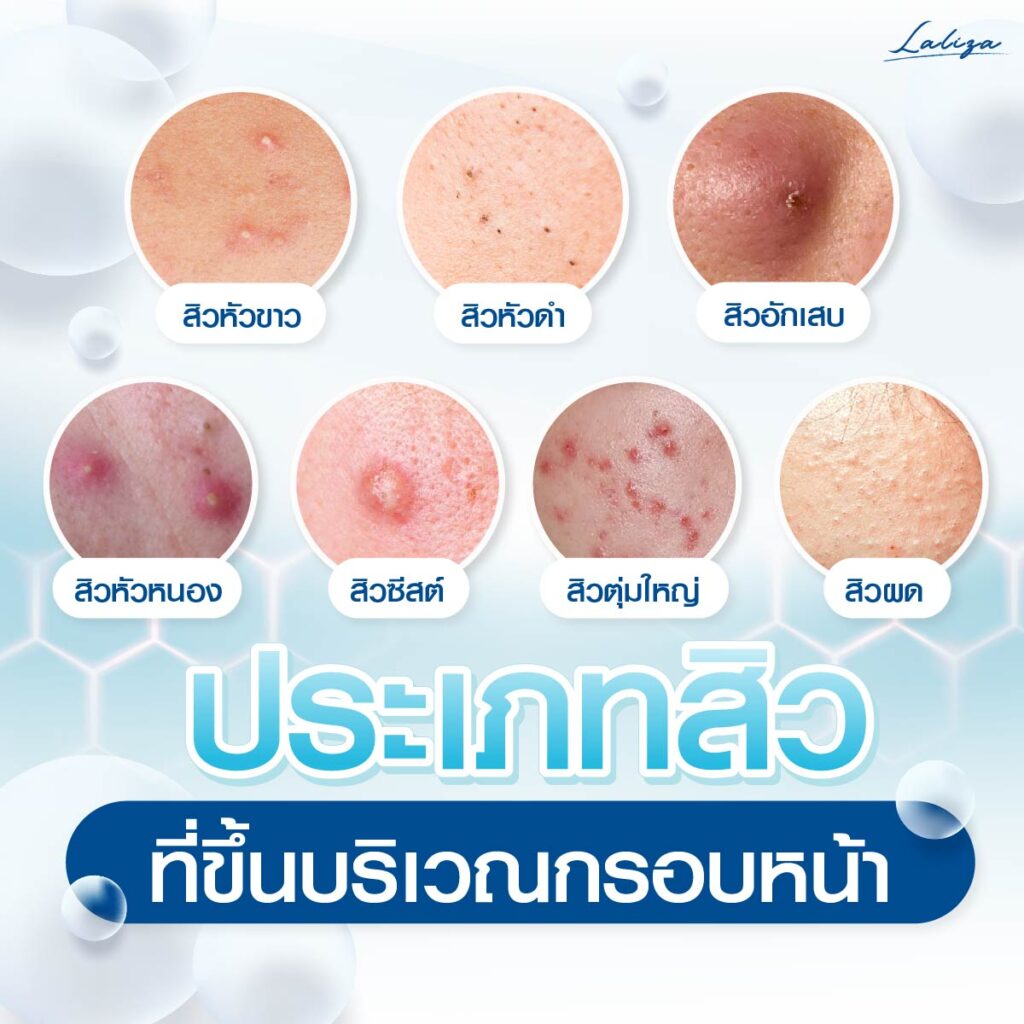 ประเภทของสิวที่มักขึ้นกรอบหน้า