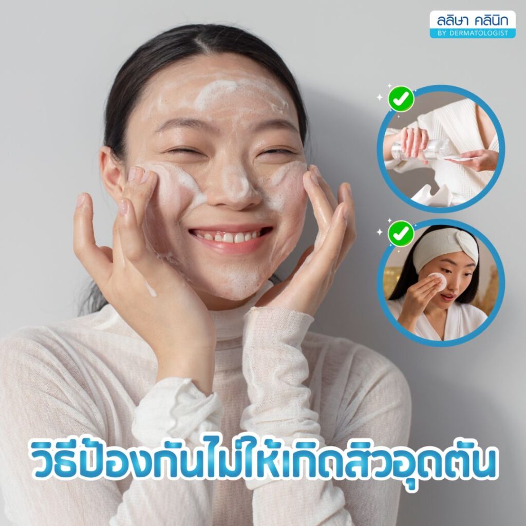 วิธีป้องกันสิวอุดตัน