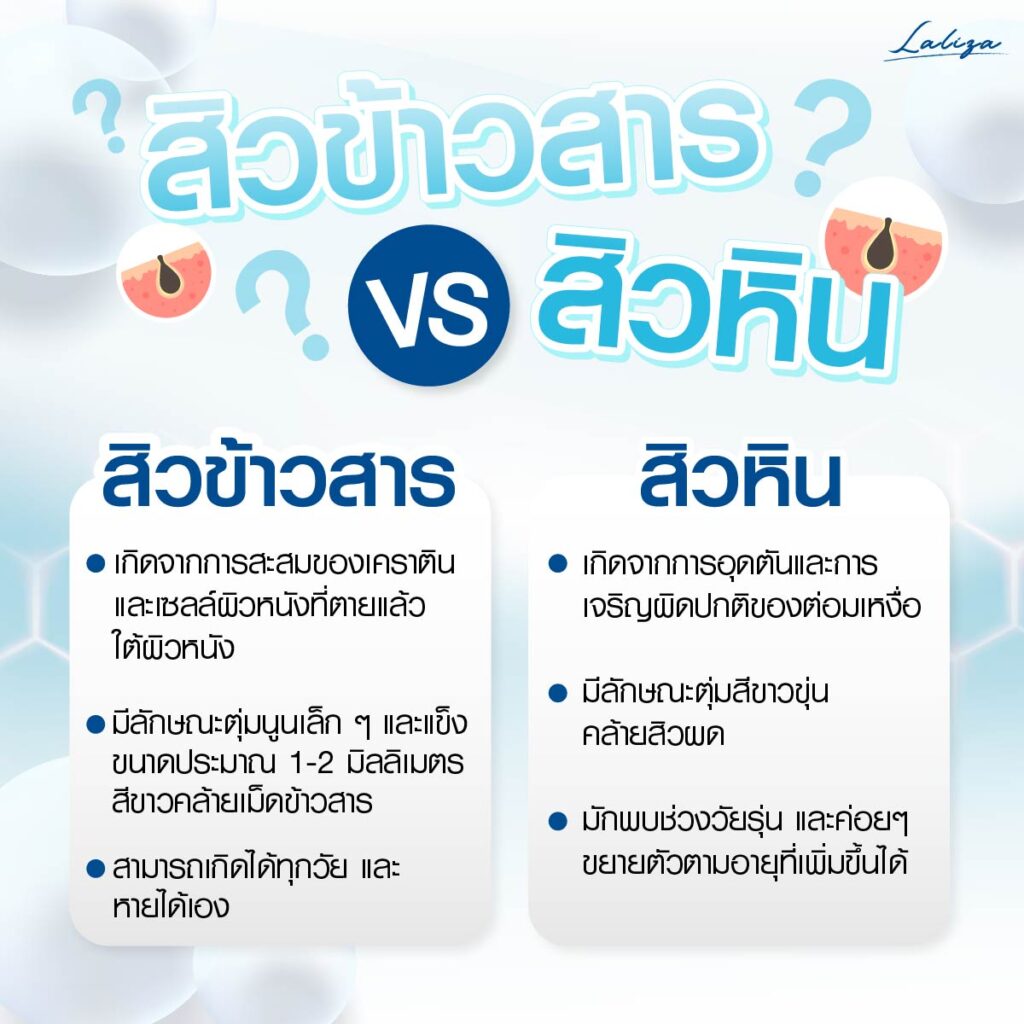 สิวข้าวสาร Vs สิวหิน