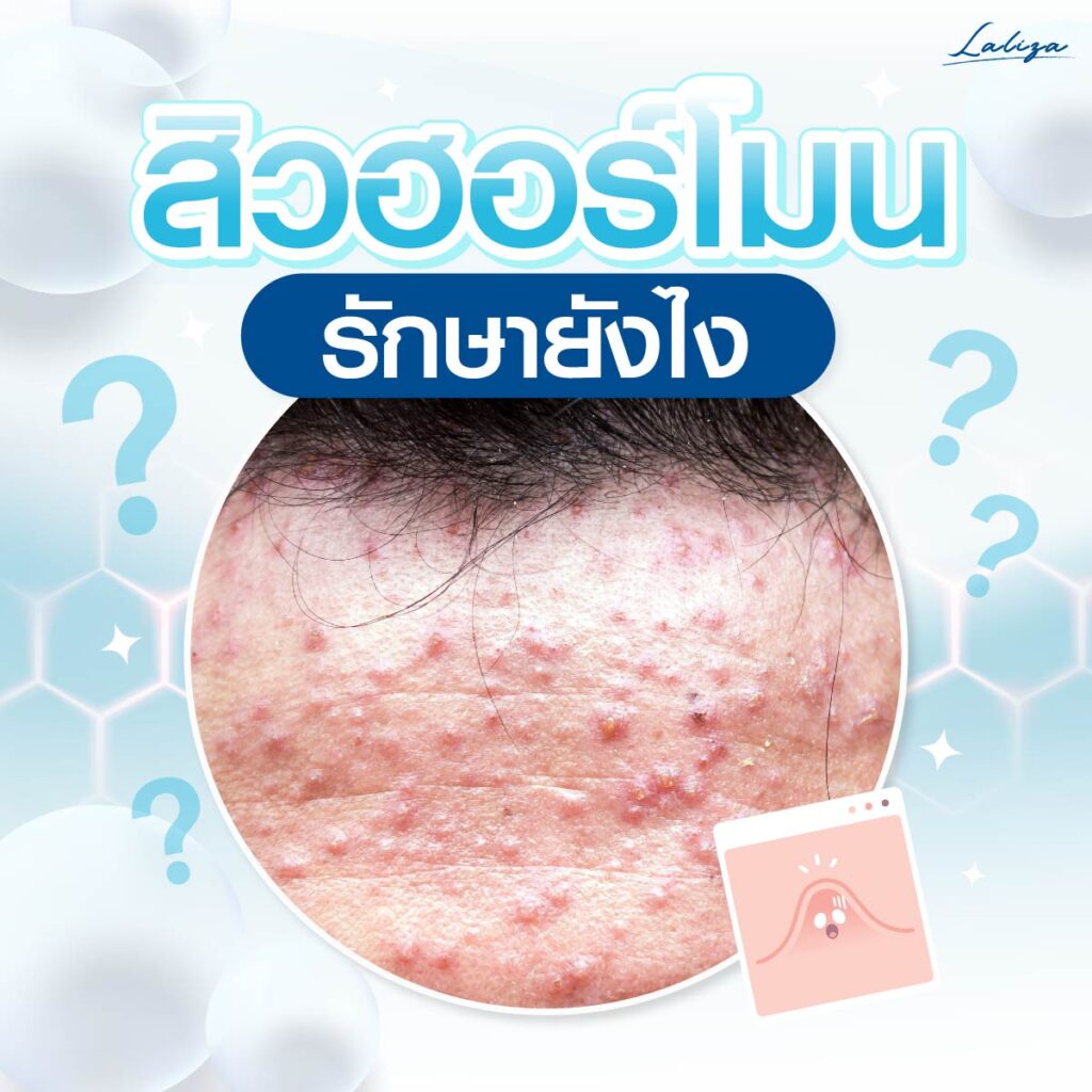 สิวฮอร์โมนรักษาอย่างไร