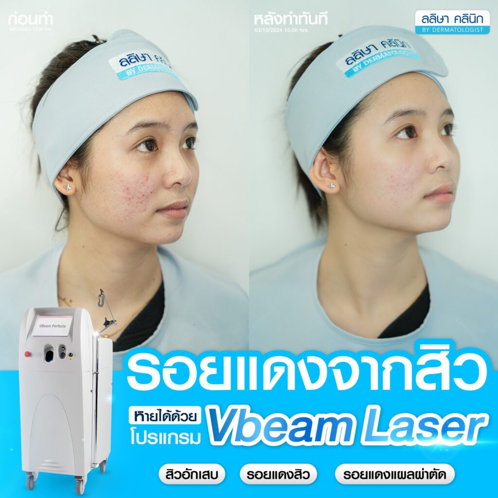 รีวิว เลเซอร์ความงาม vbeam laser เลเซอร์รอยแดง