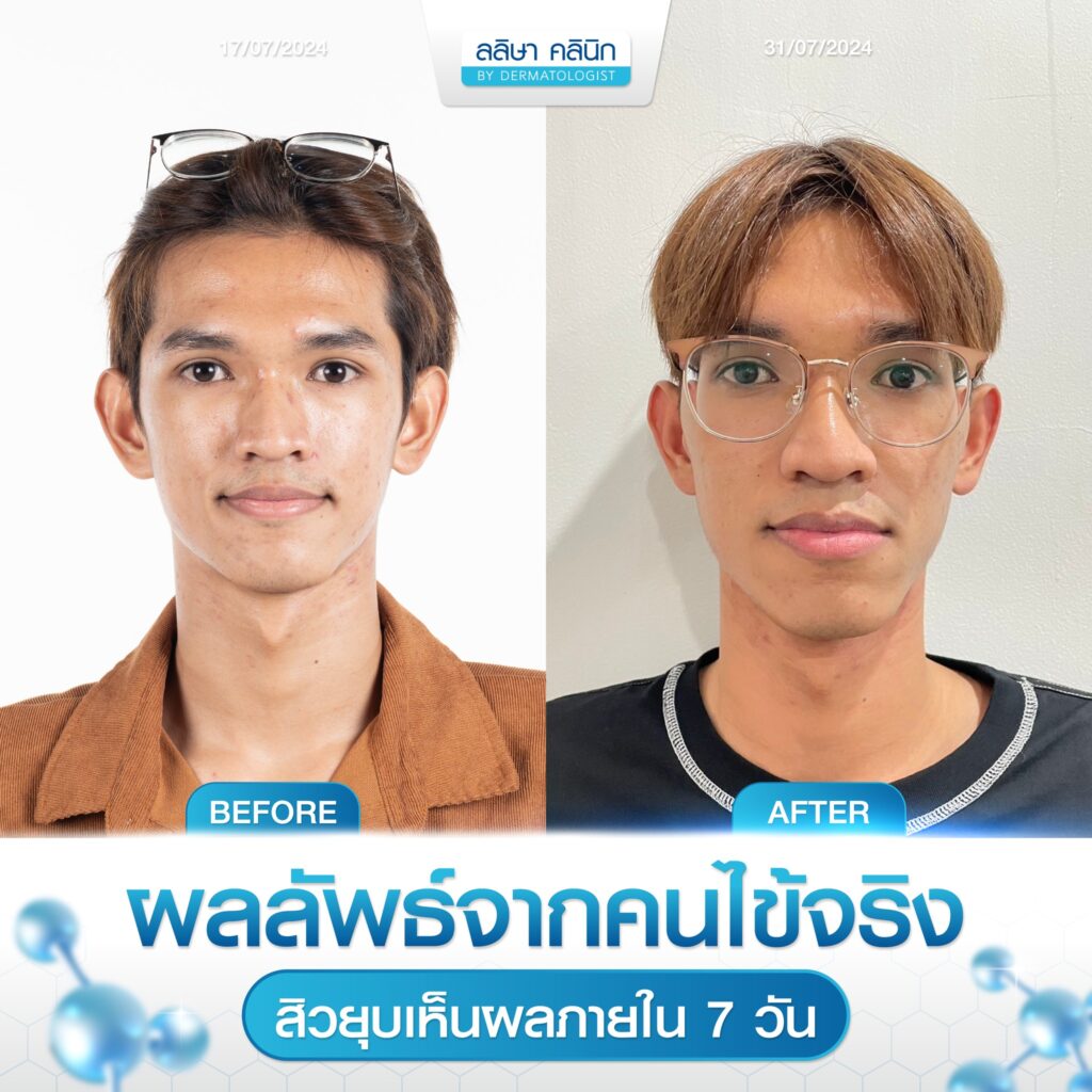 รีวิวคนไข้รักษาสิว คุณบาส