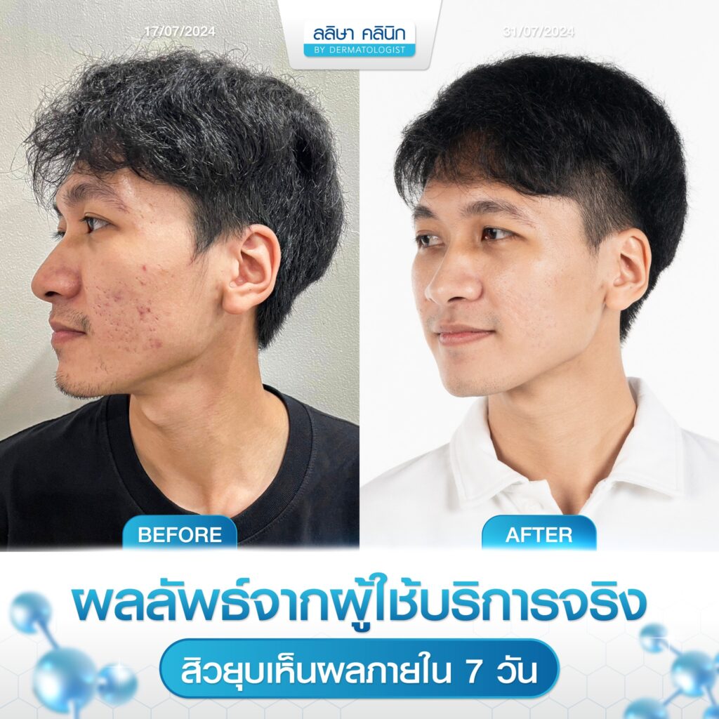 รีวิวคนไข้รักษาสิว คุณเฮง