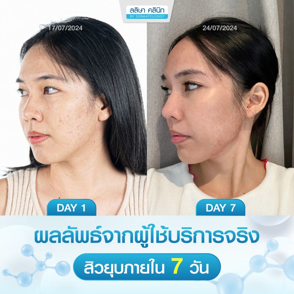 รีวิวคนไข้รักษาสิว ที่ลลิษาคลินิก