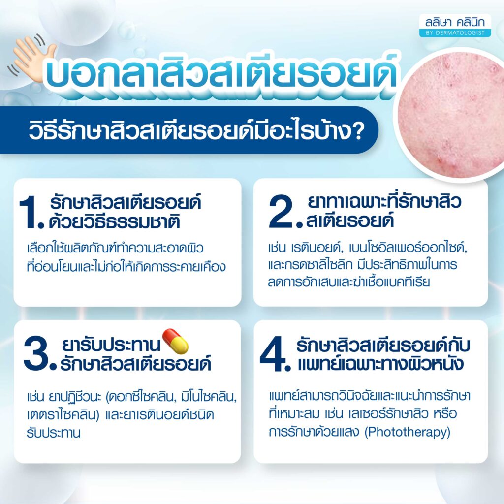 สิวสเตียรอยด์ รักษาอย่างไร