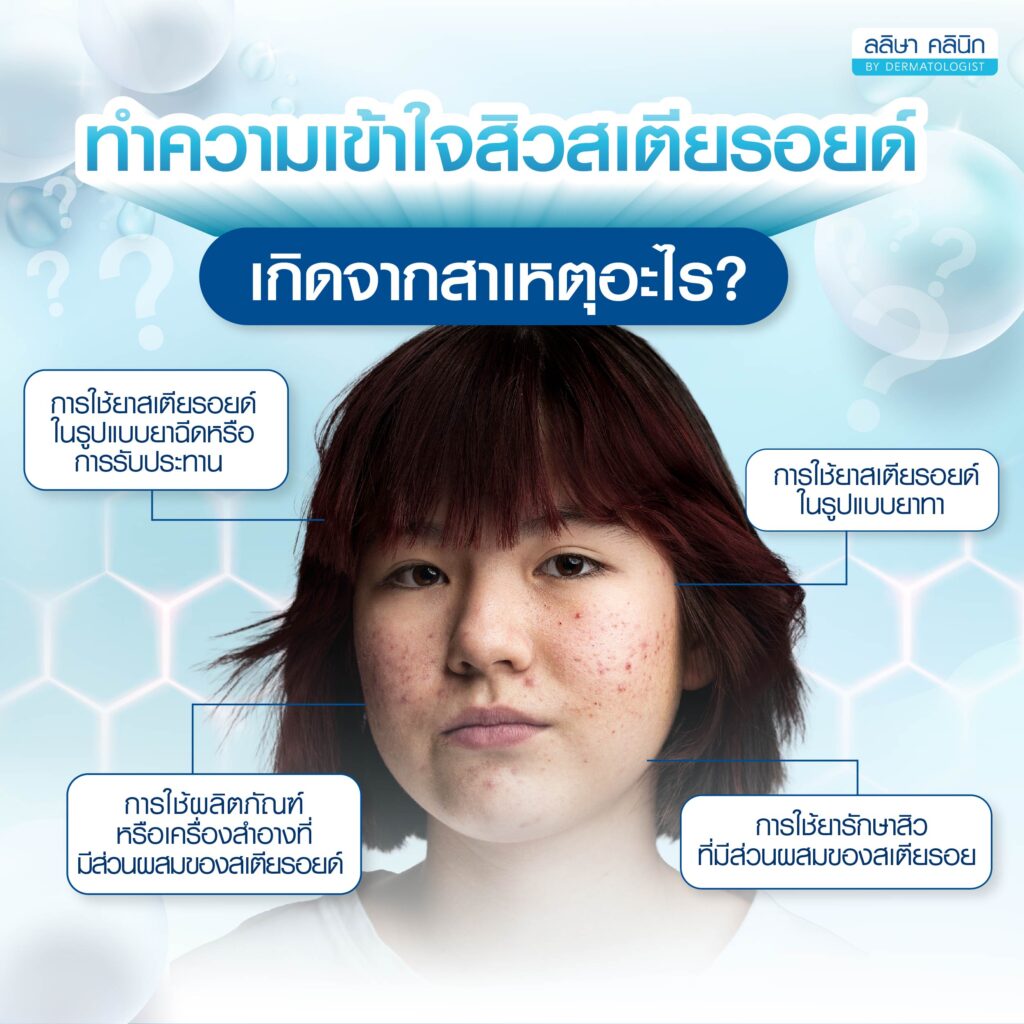 สิวสเตียรอยด์เกิดจากอะไร