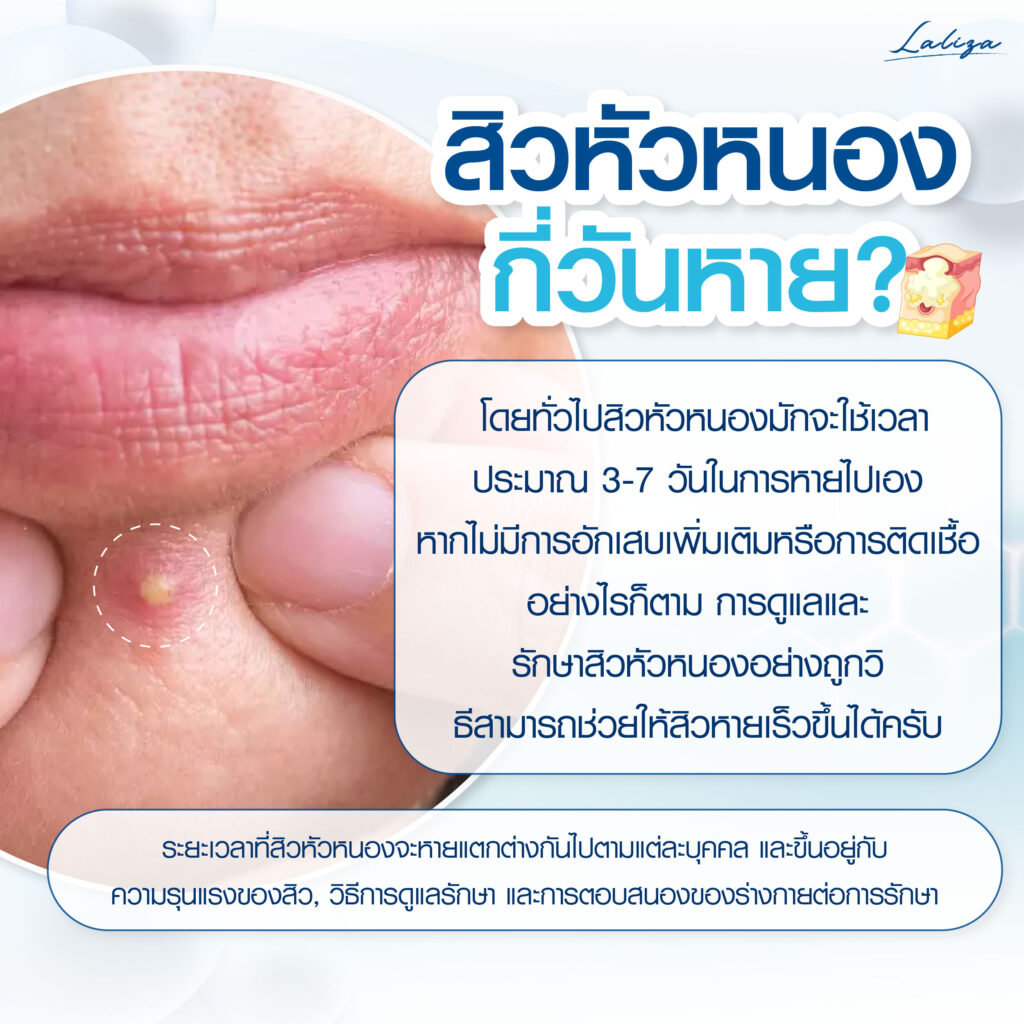 สิวหัวหนองรักษากี่วันหาย