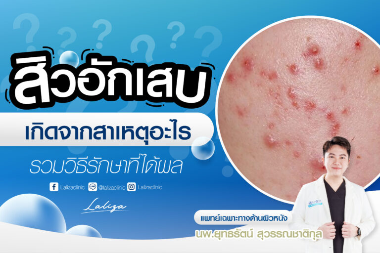 สิวอักเสบ เกิดจากอะไร รักษาอย่างไร