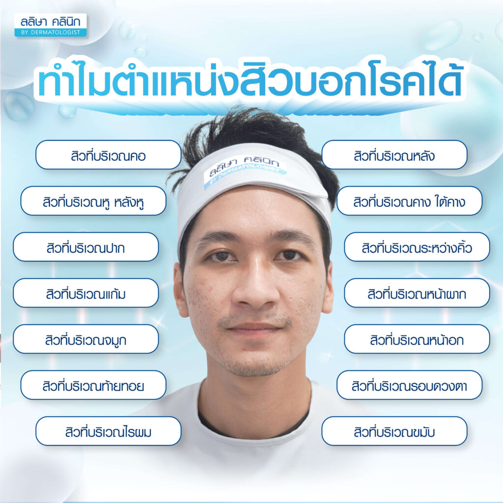 14 ตำแหน่งสิวบอกโรค