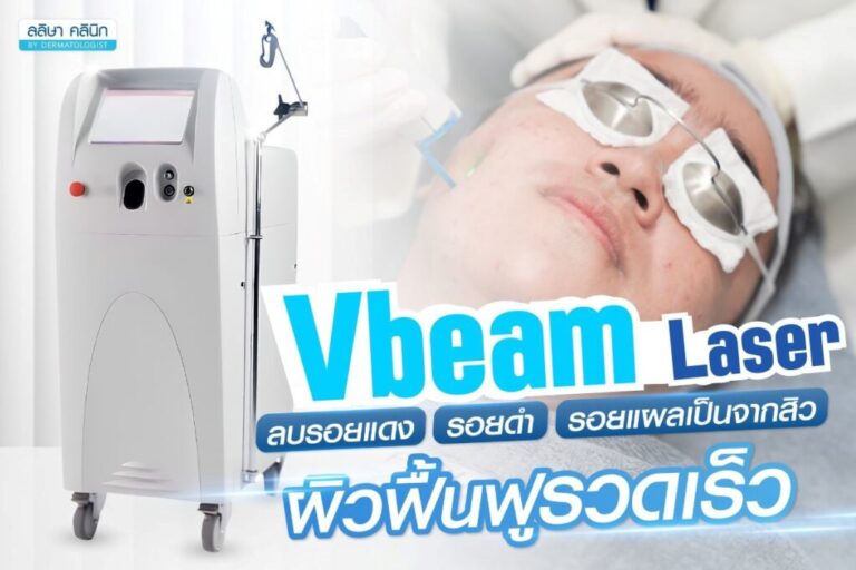 vbeam laser