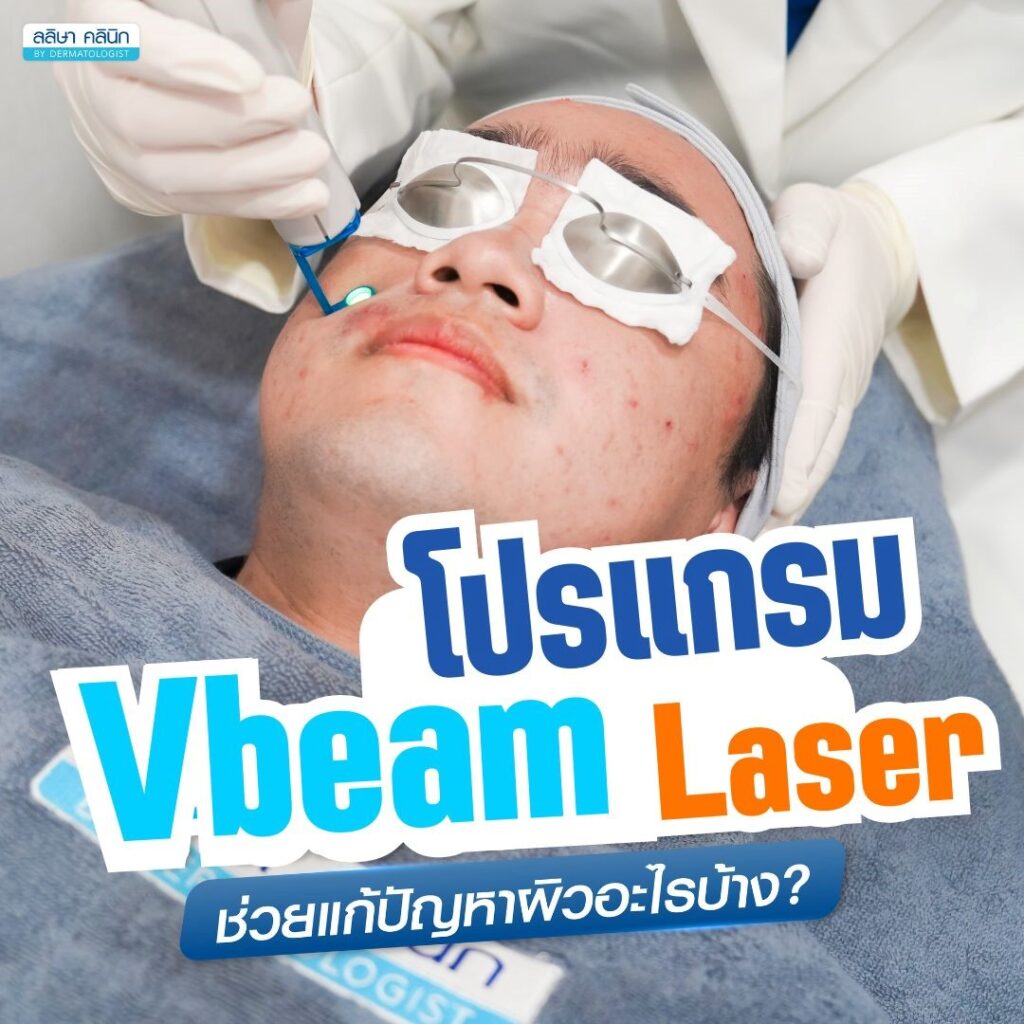 vbeam laser ช่วยอะไร