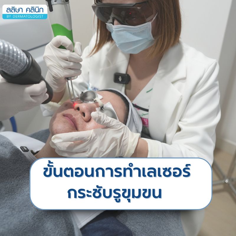 ขั้นตอนเลเซอร์กระชับรุขุมขน