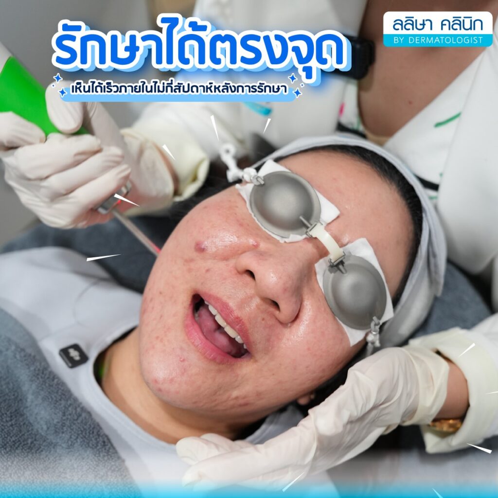 ข้อดีของการทำเลเซอร์รักษาหลุมสิว