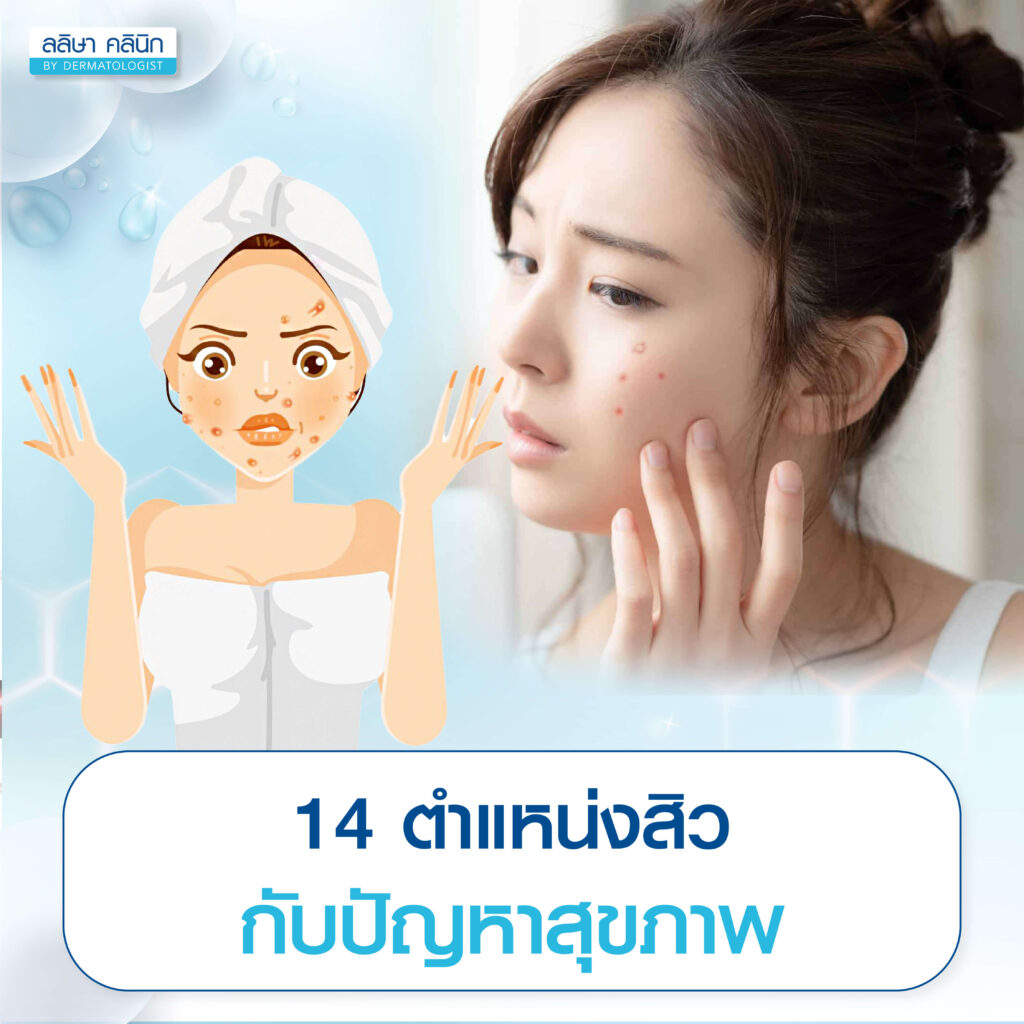 ตำแหน่งสิวเกี่ยวข้องกับโรคอย่างไร