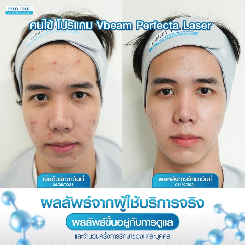 รีวิวลบรอยแดงด้วย Vbeam laser