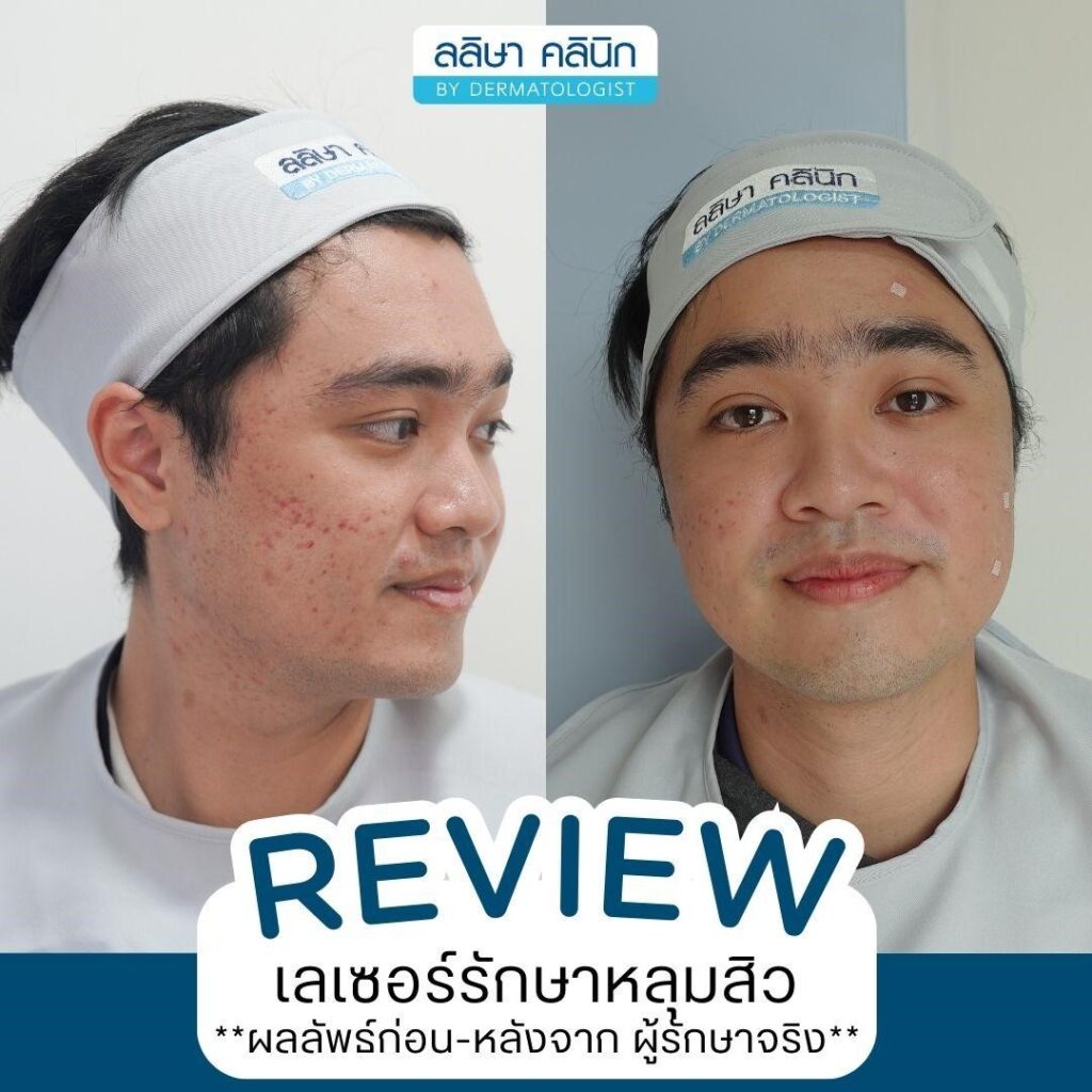 รีวิวหลังทำเลเซอร์รักษาหลุมสิว