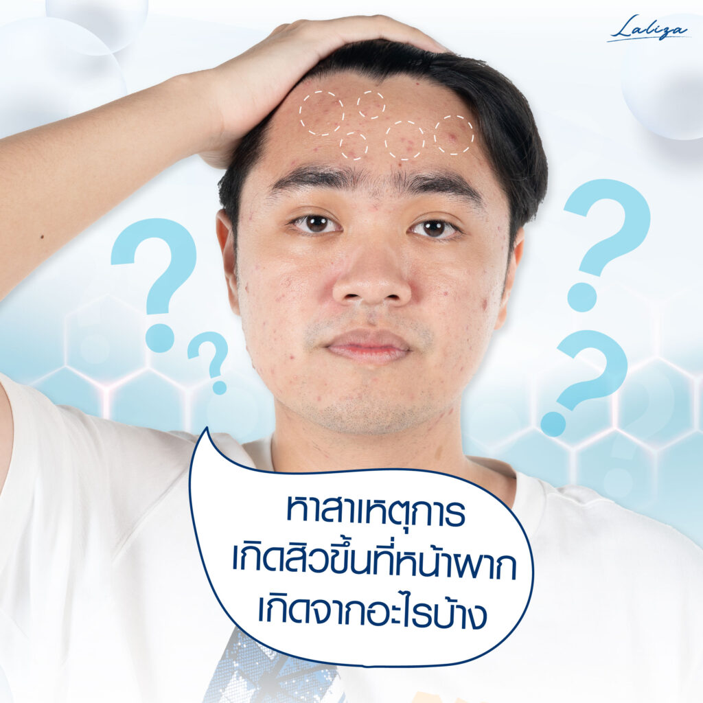 สาเหตุสิวขึ้นที่หน้าผาก