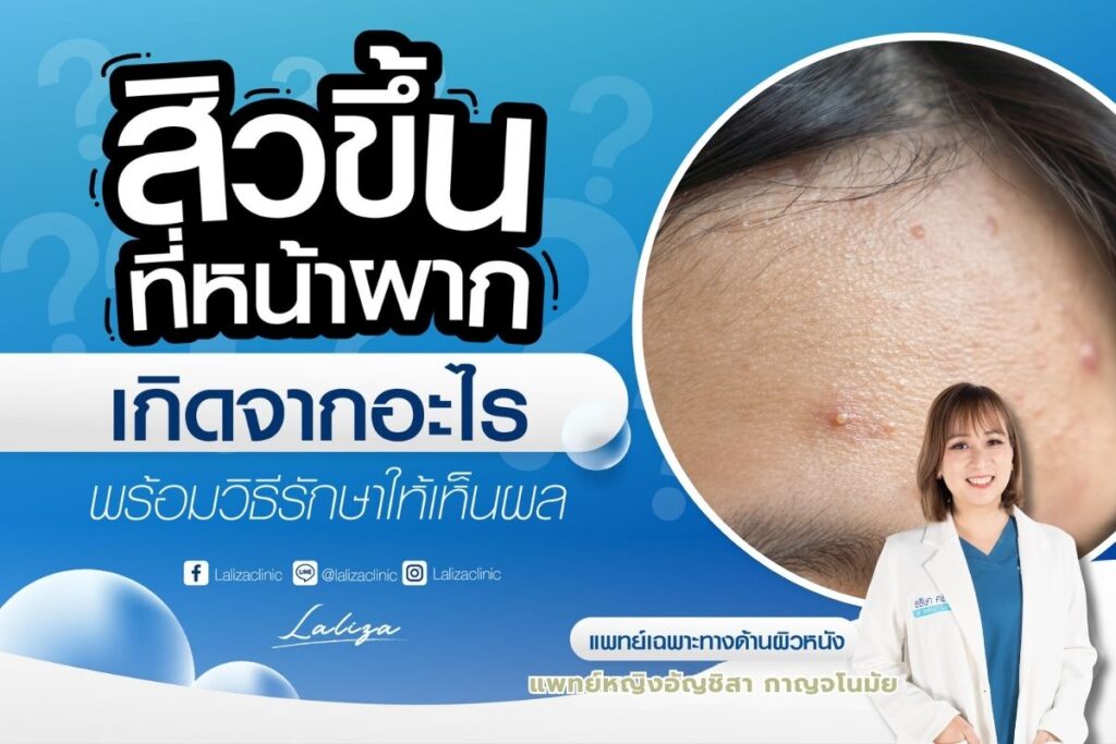 สิวที่หน้าผาก สาเหตุ วิธีป้องกัน รักษาอย่างไร