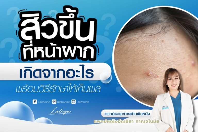 สิวที่หน้าผาก สาเหตุ วิธีป้องกัน รักษาอย่างไร