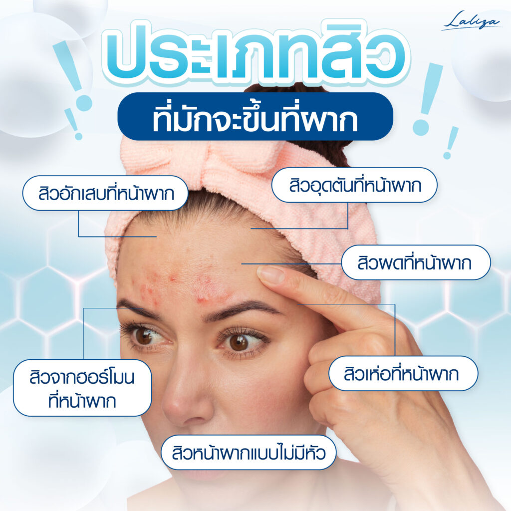 สิวประเภทไหนชอบขึ้นที่หน้าผาก