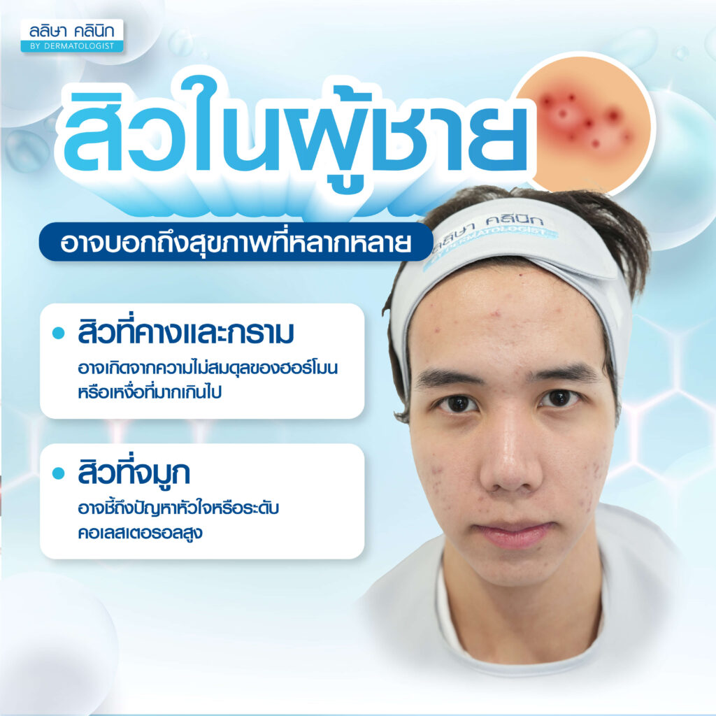 สิวในผู้ชาย