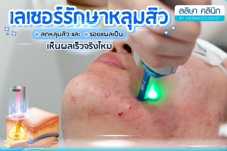 เลเซอร์หลุมสิว เหมาะกับหลุมสิวแบบไหน ทำแล้วถึงเห็นผล