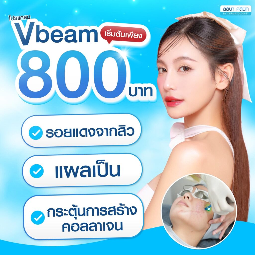 โปรโมชั่น vbeam laser ราคา เริ่มต้น 800 บาท