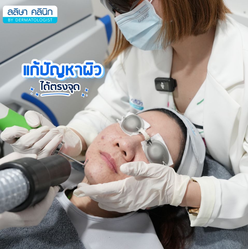 รีวิวpicol​aser