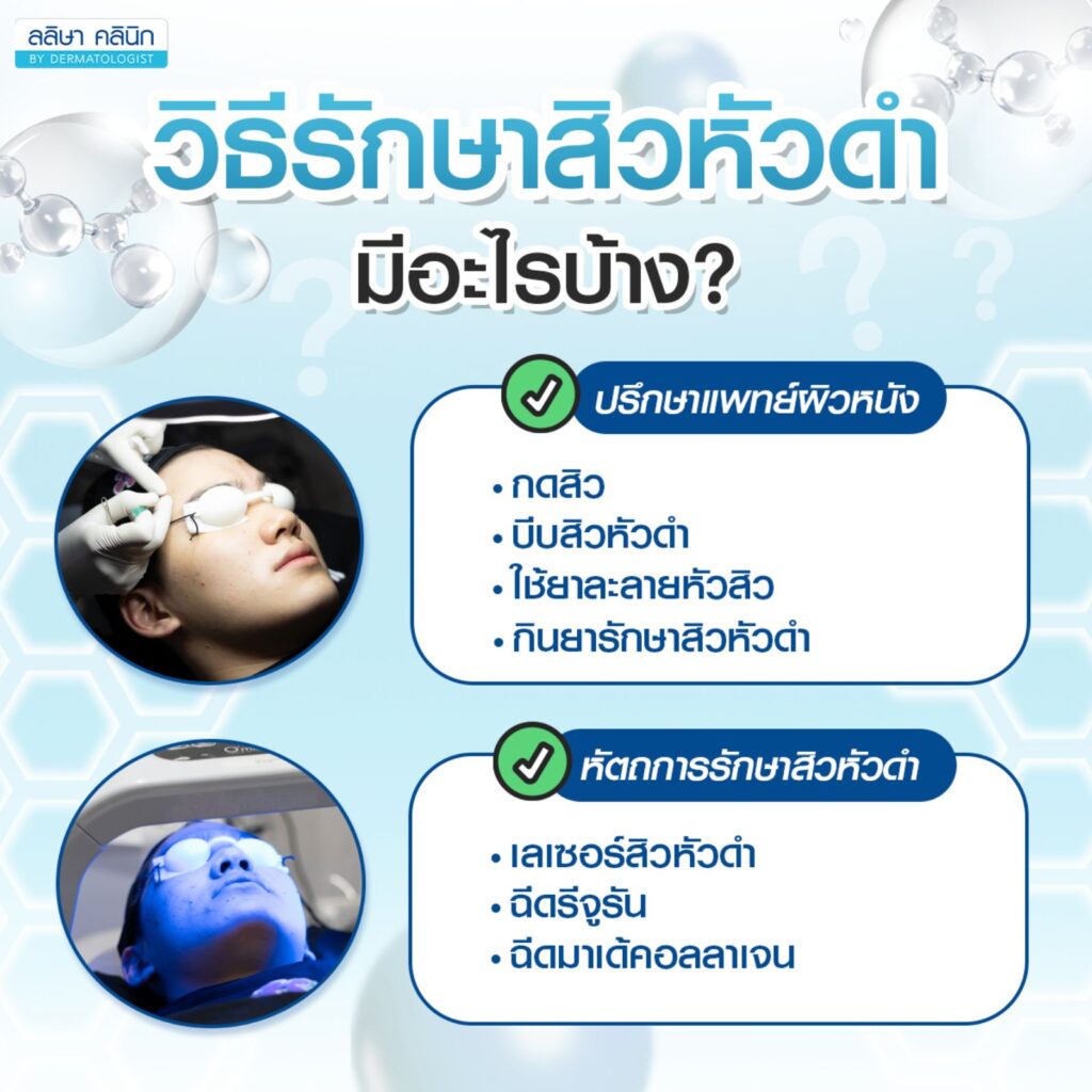 วิธีรักษาสิวหัวดำ