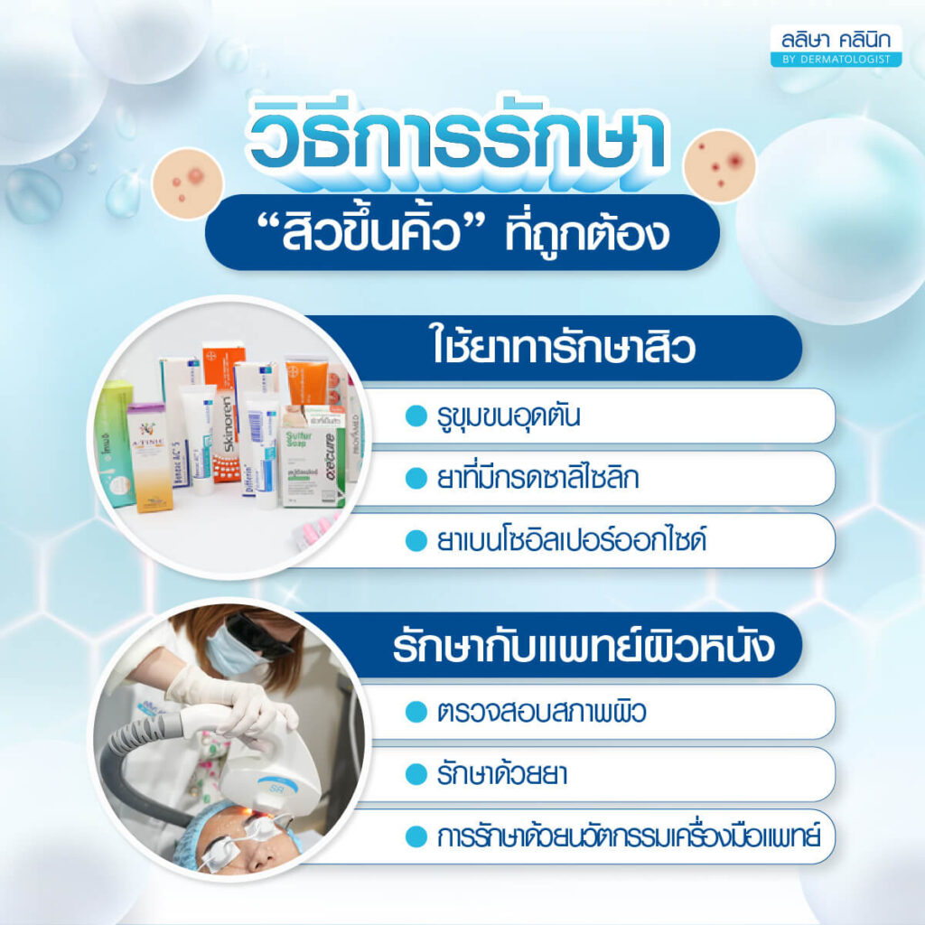 สิวขึ้นคิ้วรักษาอย่างไร