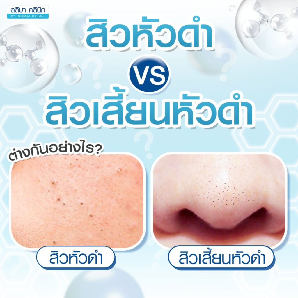 สิวหัวดำvsสิวเสี้ยนหัวดำ