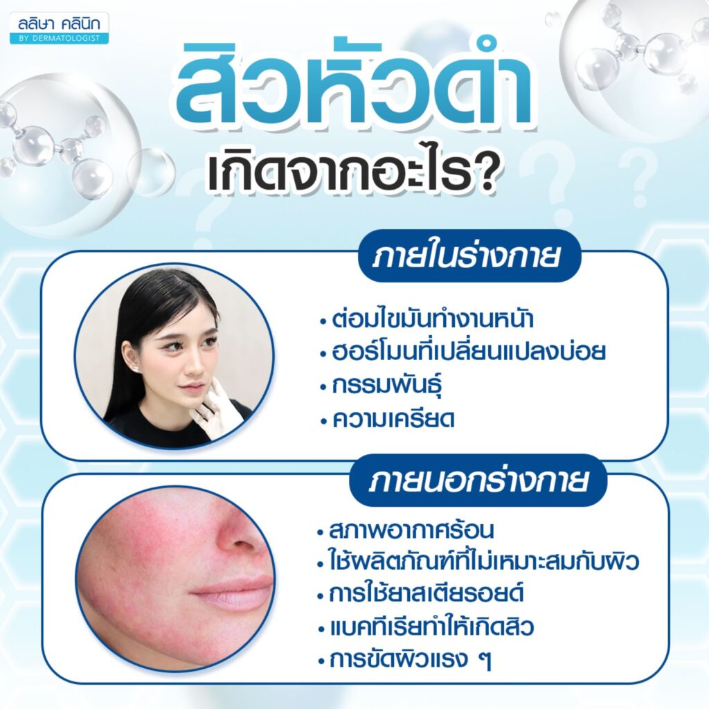 สิวหัวดำเกิดจากอะไร