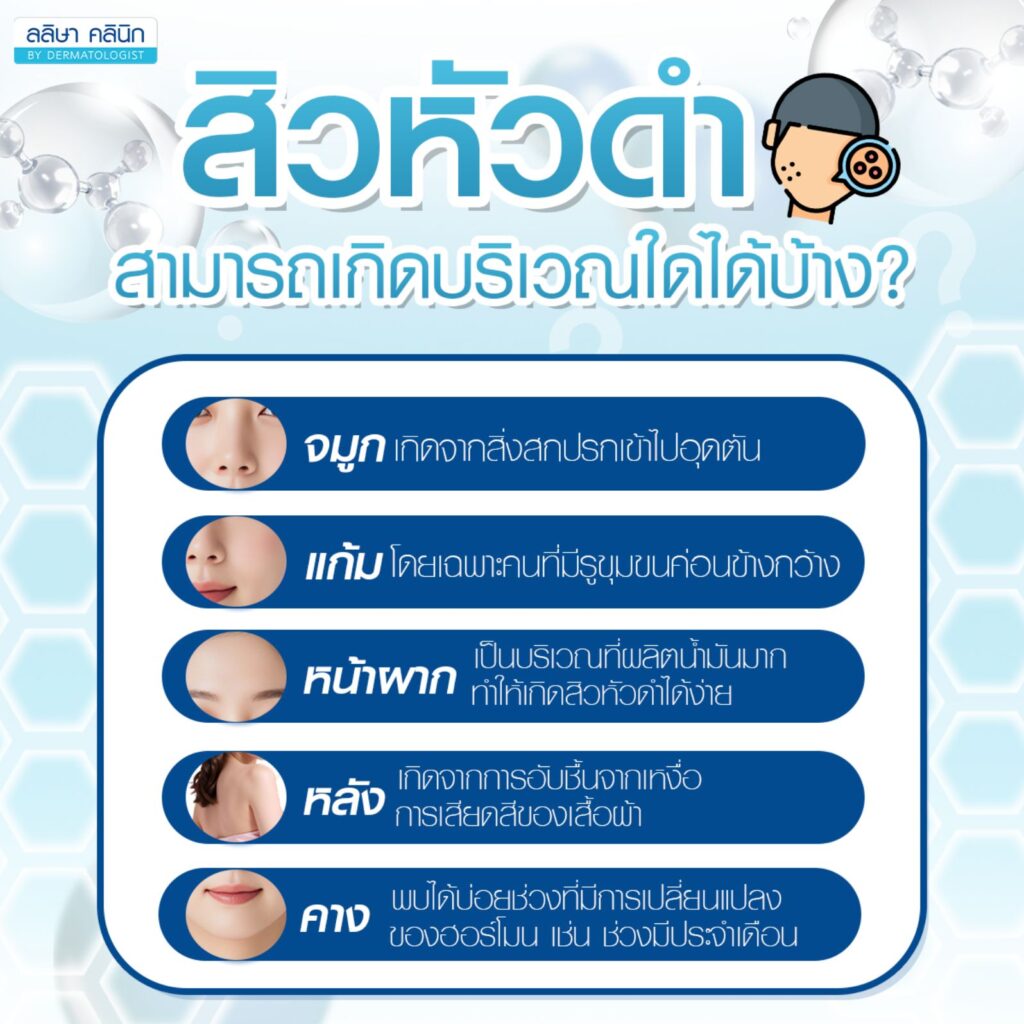 สิวหัวดำเกิดบริเวณไหนบ้าง