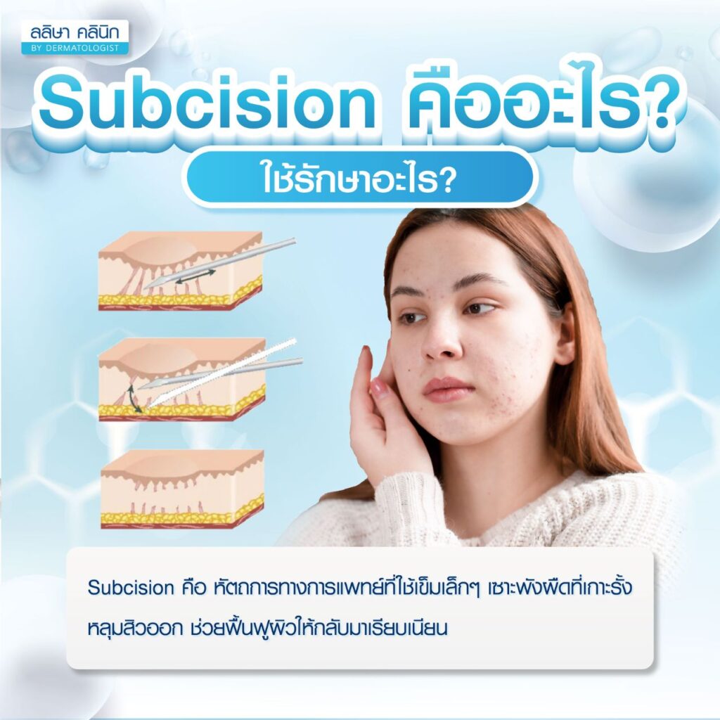 Subcision คืออะไร