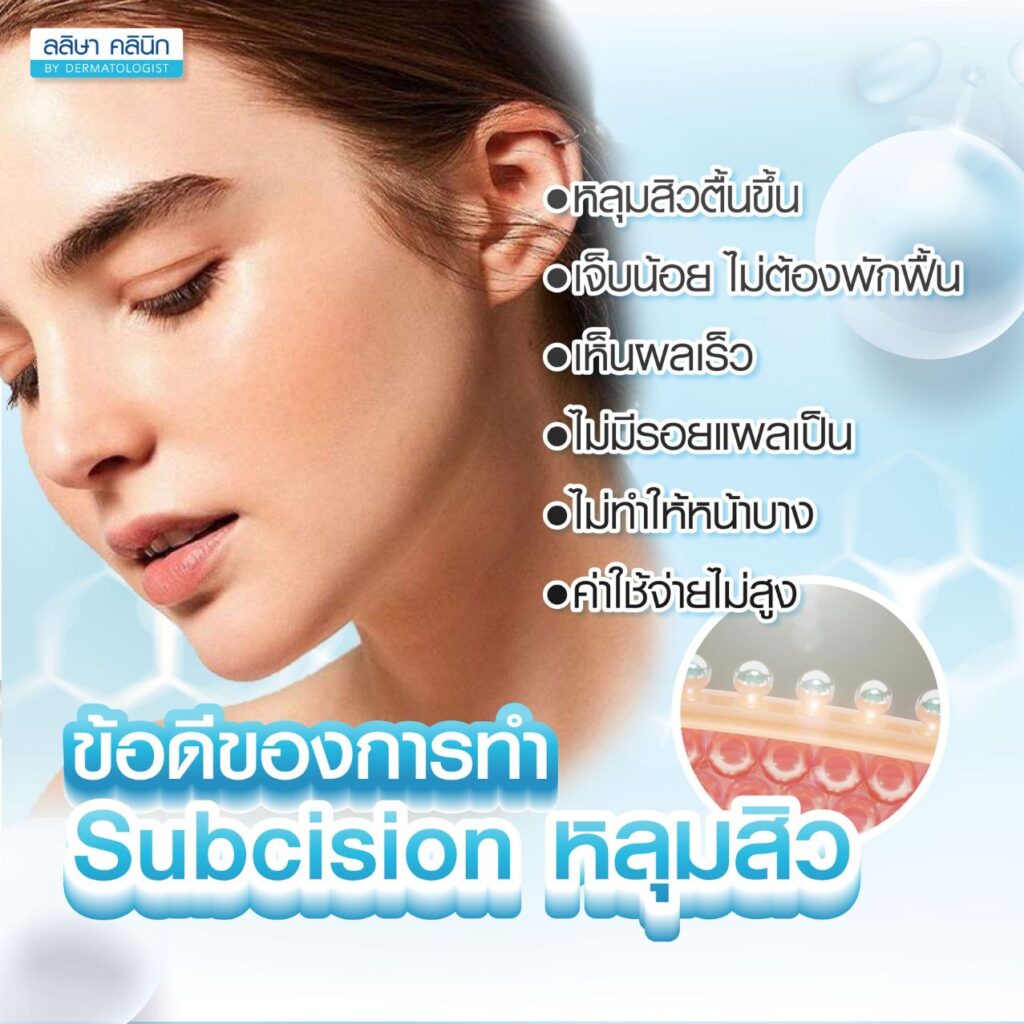 ข้อดีการทำ Subcision หลุมสิว