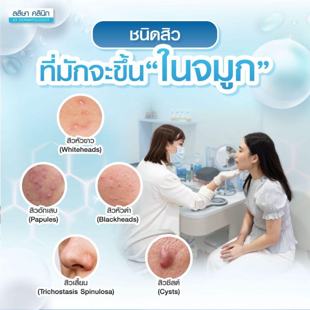 ชนิดสิวที่ขึ้นในจมูก