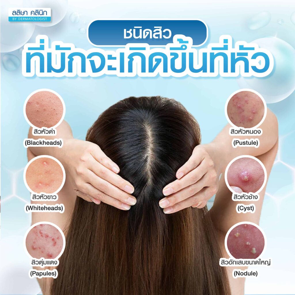 ชนิดสิวที่มักจะเกิดขึ้นที่หัว