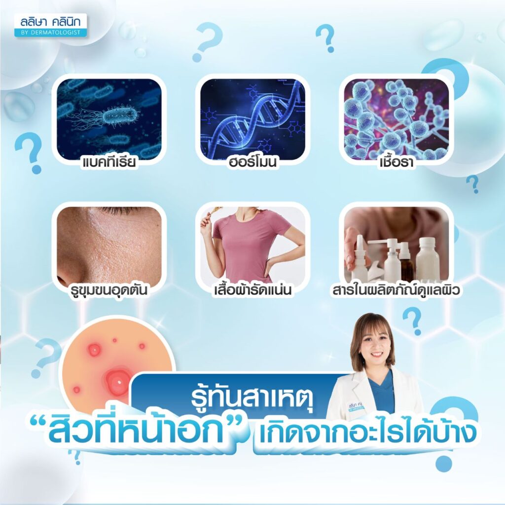 สิวที่หน้าอกเกิดจากอะไร