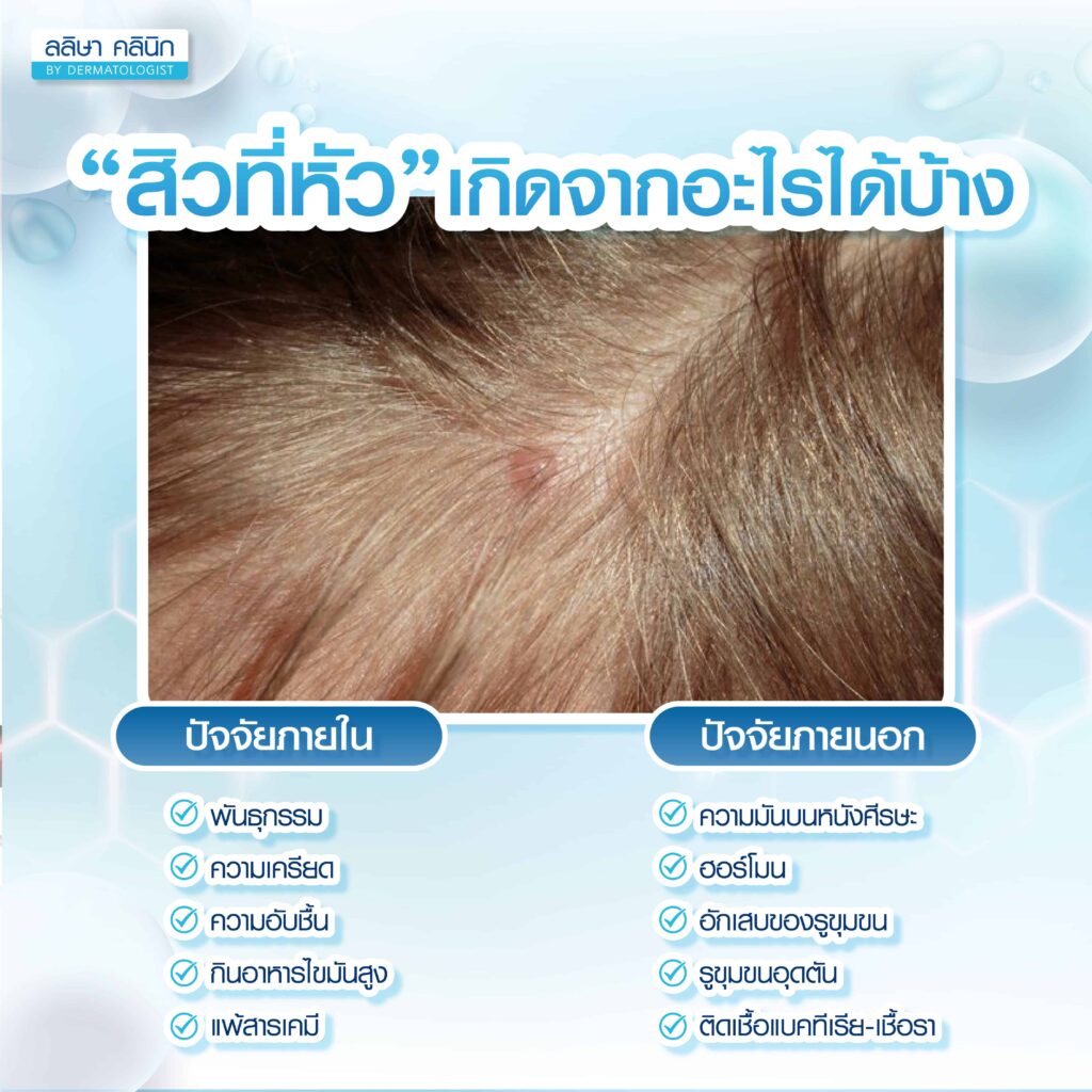 สิวที่หัวเกิดจากอะไร