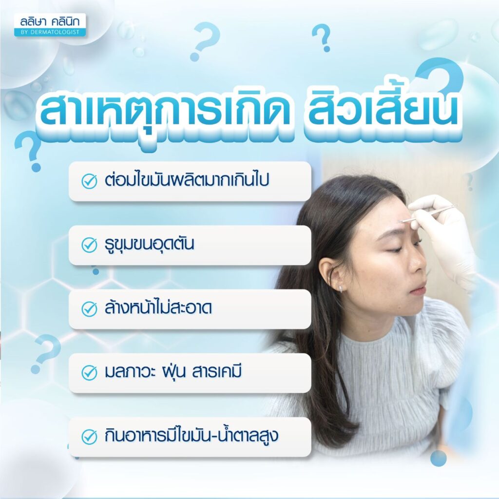 สิวเสี้ยนเกิดจากอะไร