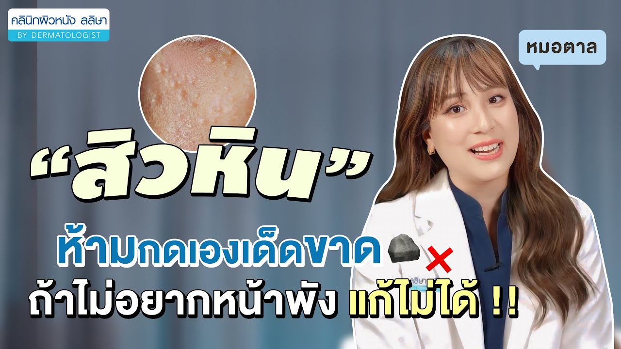 คลิป สิวหิน คืออะไร ลักษณะอย่างไร โดยหมอตาล คลินิกผิวหนังลลิษา