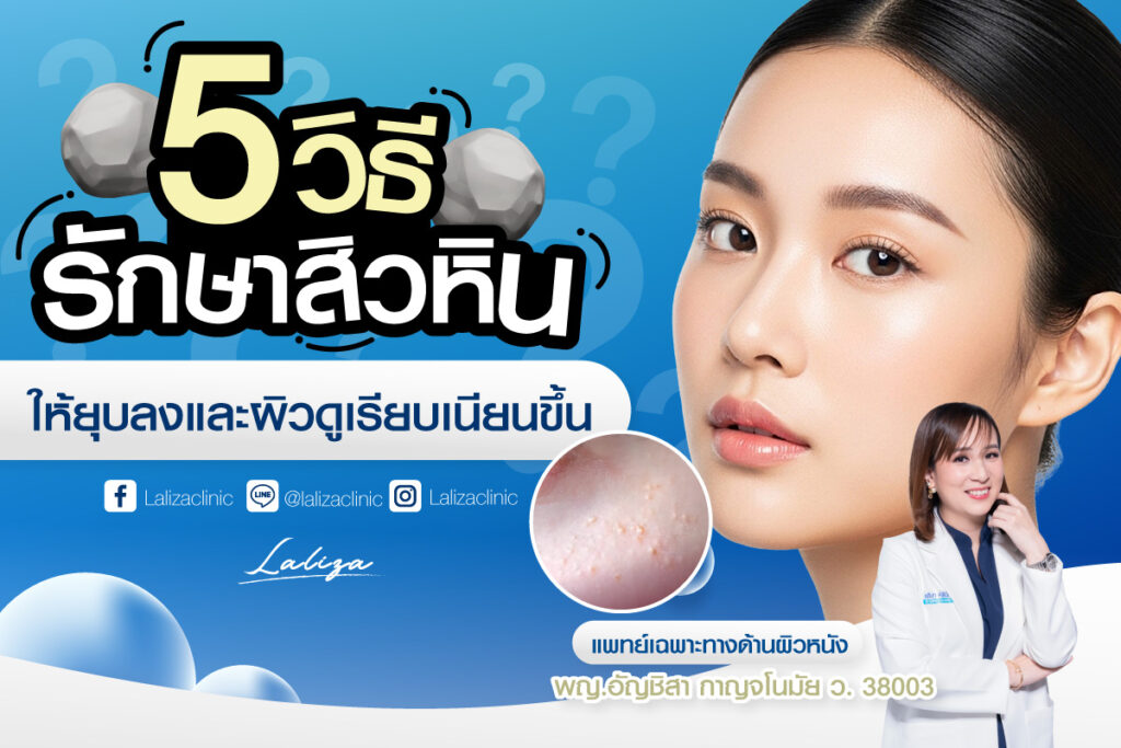 สาเหตุสิวหิน ตำแหน่งเกิด การรักษาสิวหิน