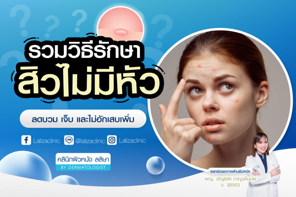 สิวไม่มีหัว