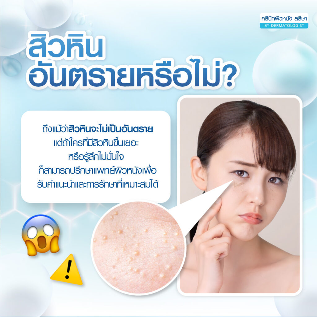 อันตรายจากสิวหิน