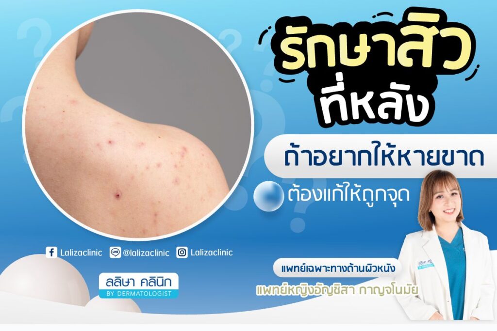 Acne on the back