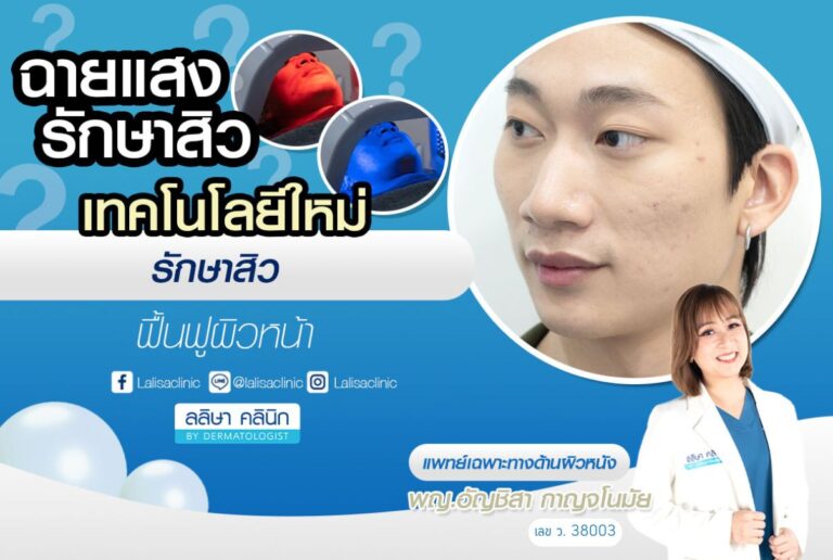 ฉายแสงรักษาสิว คืออะไร ช่วยเรื่องอะไรบ้าง ปลอดภัยแค่ไหน