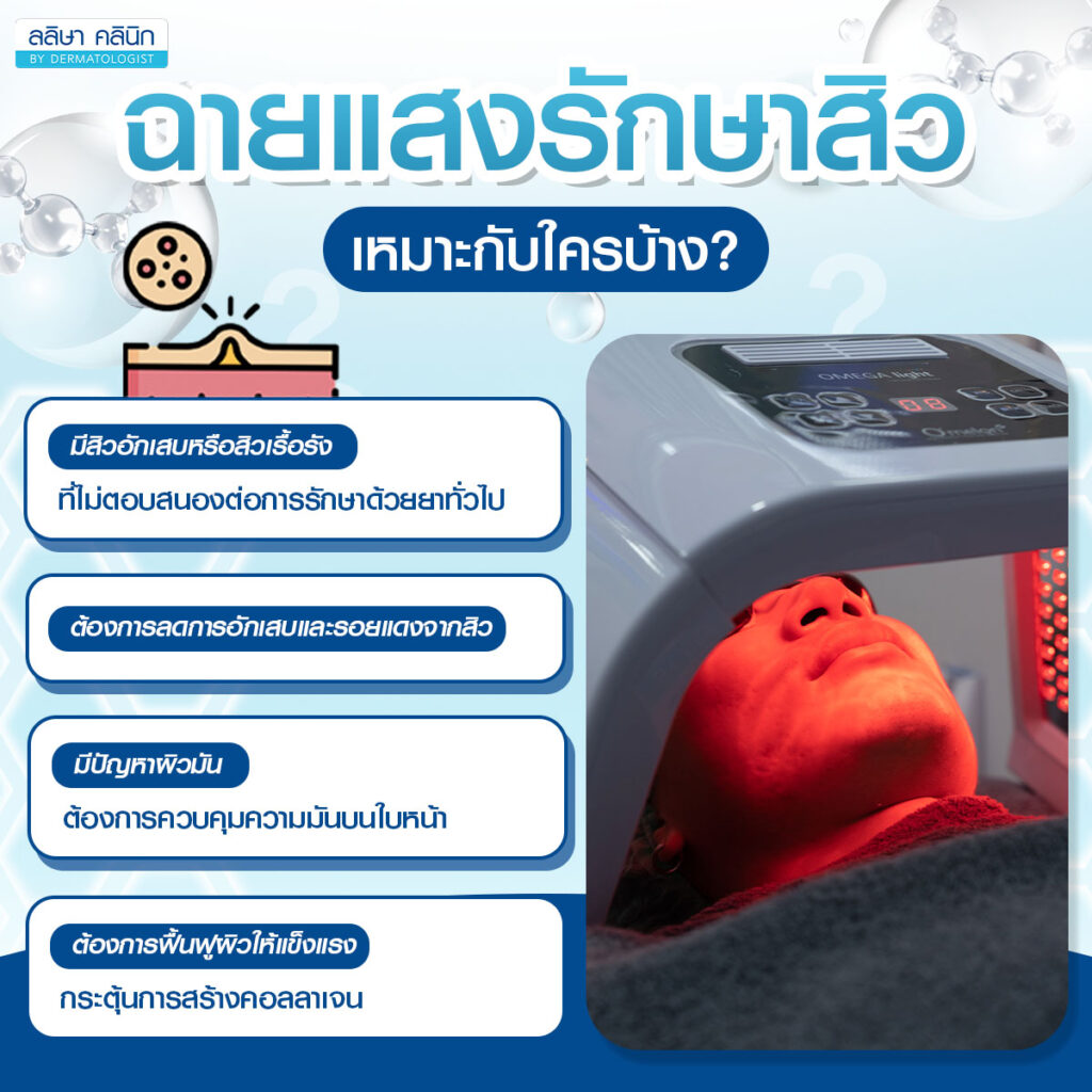 ฉายแสงรักษาสิว เหมาะกับใคร