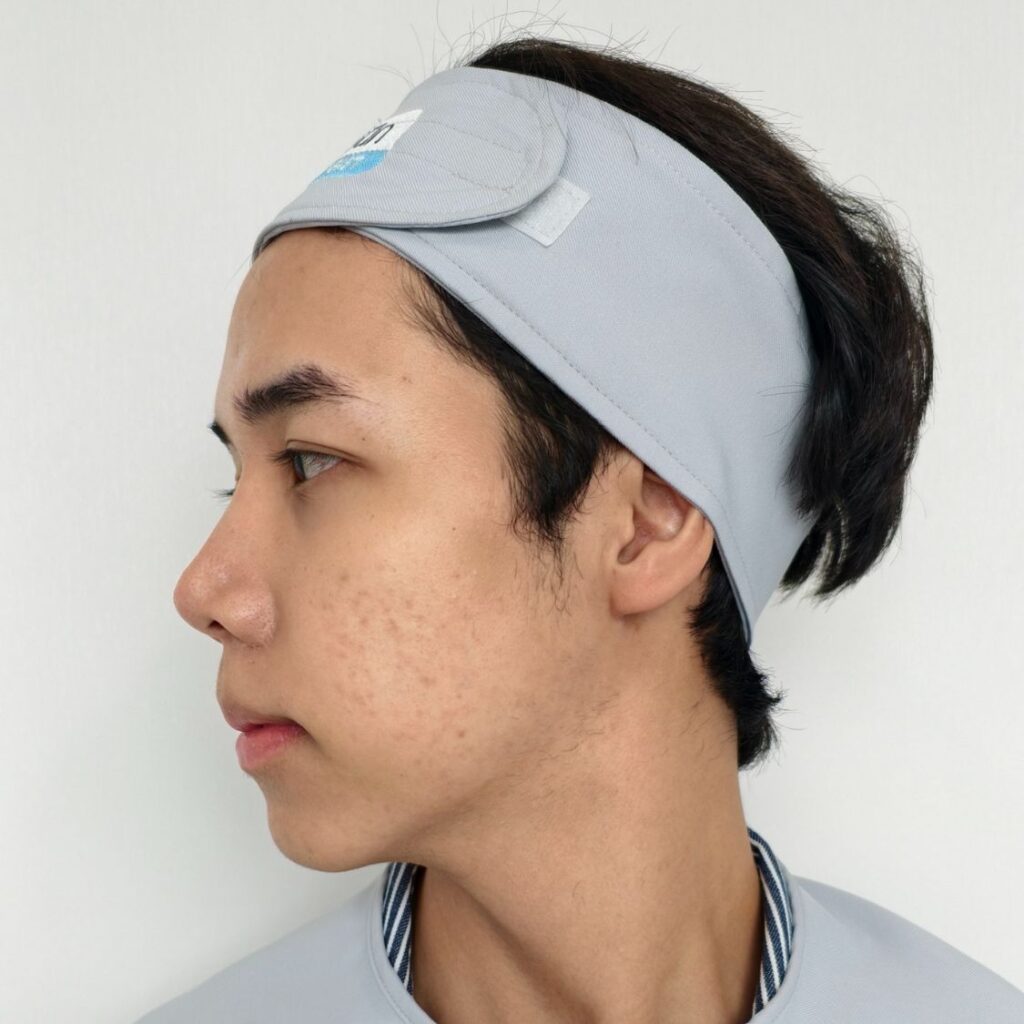 ชนิดสิวผดในหน้าร้อน