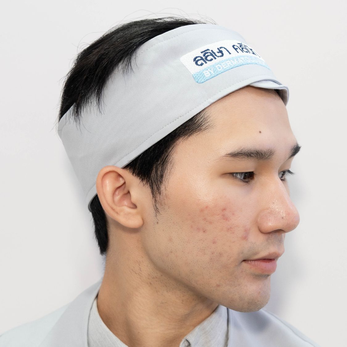 ชนิดสิวอักเสบในหน้าร้อน