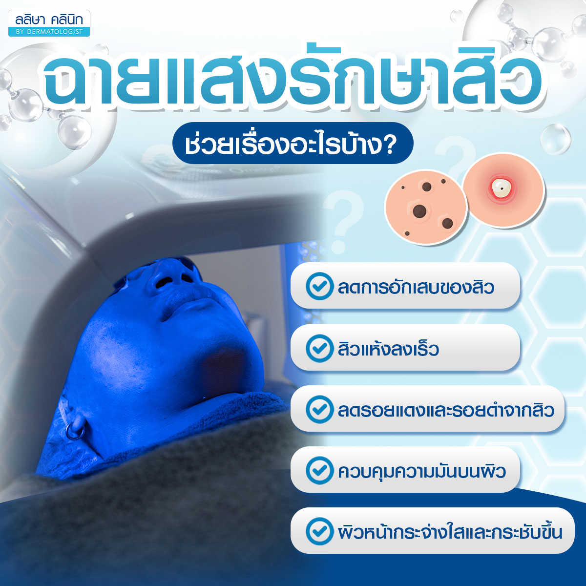 ประโยชน์ฉายแสงรักษาสิว